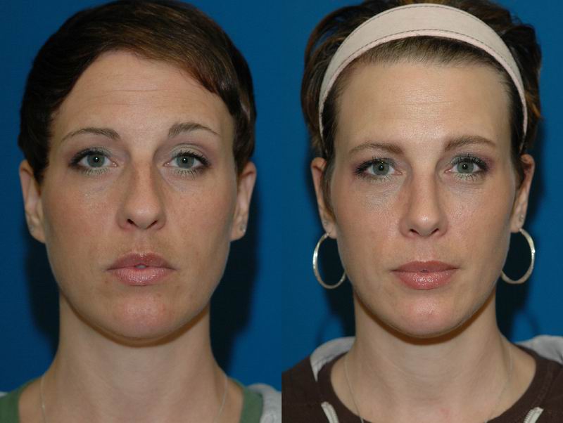 Considering a Nose Job? Consider the Non-Surgical Nose job!