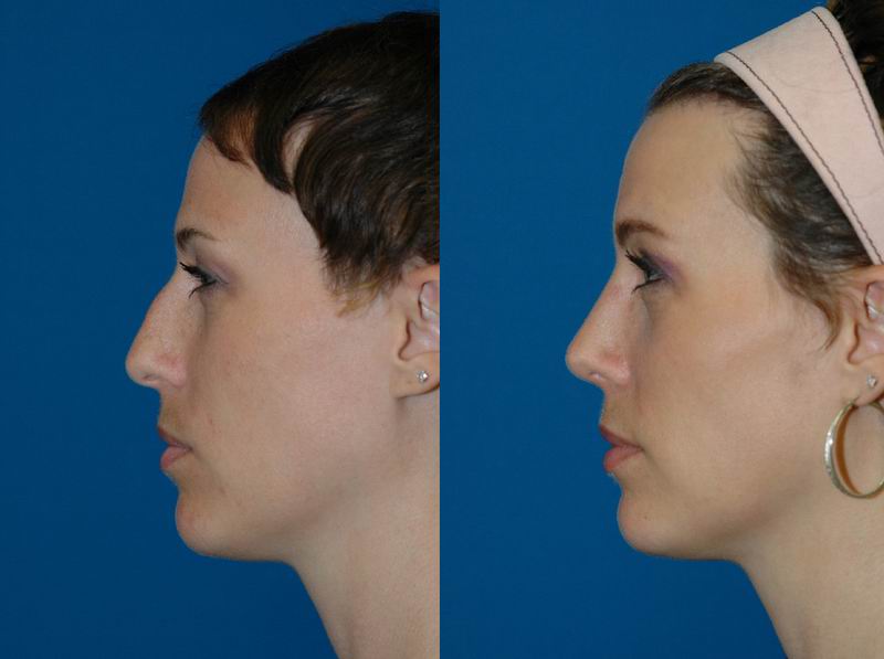 Ethnic Rhinoplasty - Seattle Facial Plastic Surgeon- DrLamperti - Seattle, WA