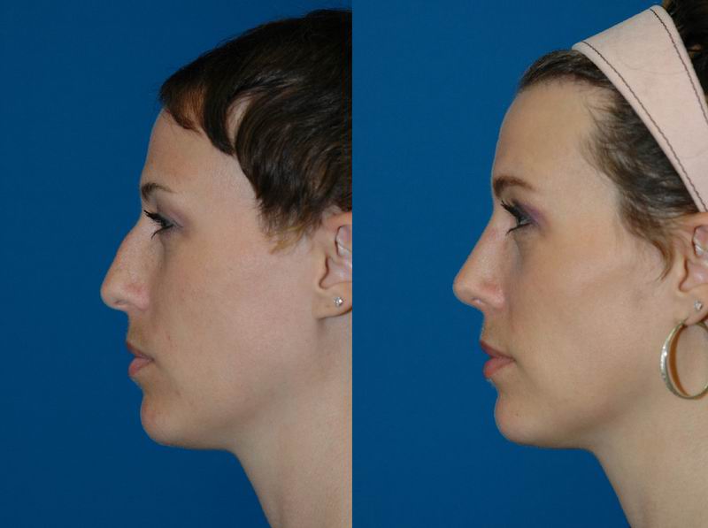 primary_rhinoplasty_0143.jpg