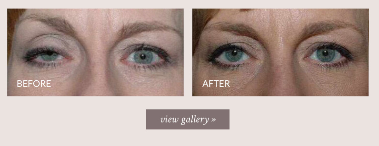 ptosis-gallery.jpg