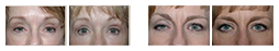 ptosis-repair-2.png