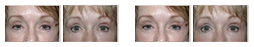 ptosis-repair.png