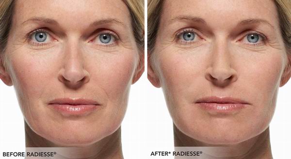 Radiesse Injection Seattle Radiesse Filler Bellevue