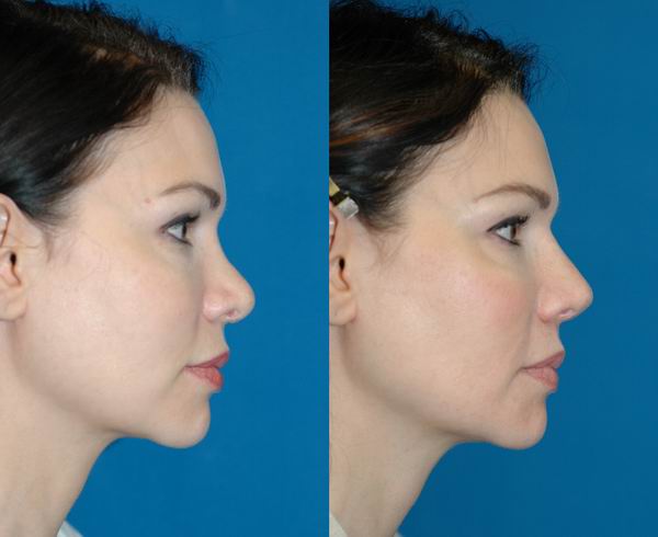 revision_rhinoplasty_seattle03.jpg