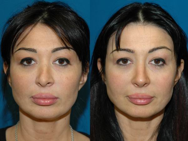 revision_rhinoplasty_seattle05.jpg