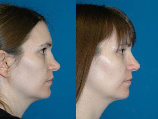 revision_rhinoplasty_seattle06.jpg