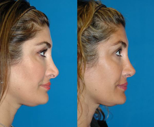 revision_rhinoplasty_seattle07.jpg