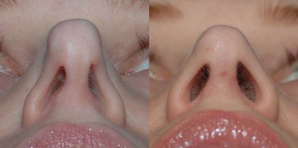 revision_rhinoplasty_seattle09.jpg