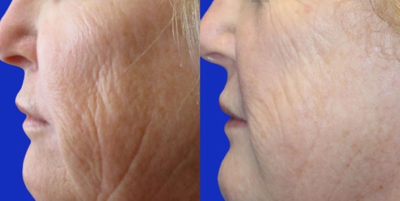 rf_microneedling_800.jpg