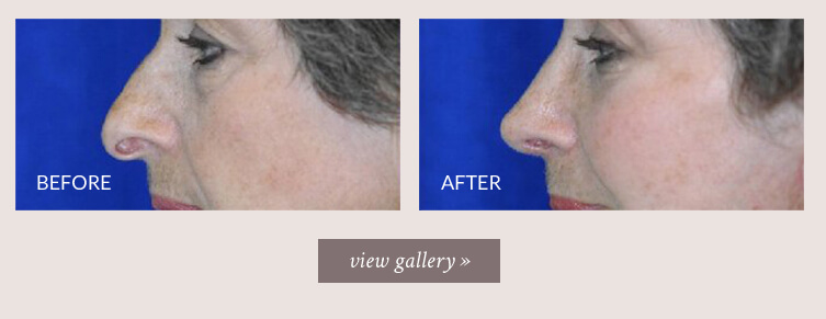 Bellevue-Seattle Rhinoplasty - Surgical Nose Job Surgery in Seattle, WA