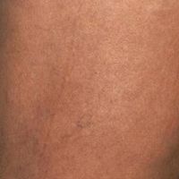 After sclerotheraphy