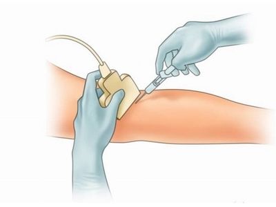 Schlerotherapy procedure illustration