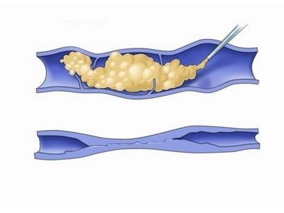 After injection of sclerosing agent vein illustration