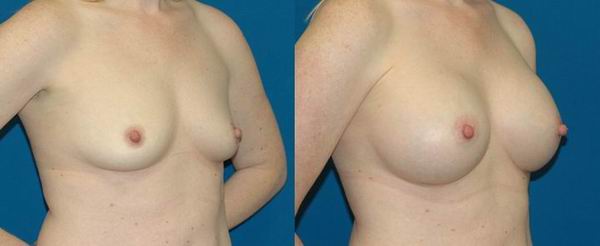 seattle_breast_implant05a.jpg