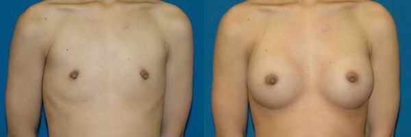 seattle_breast_implant13c.jpg