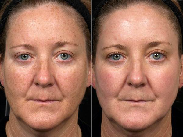 Fraxel Laser For Acne Scars Before And After