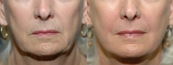 Best CO2 Laser Resurfacing Near Me