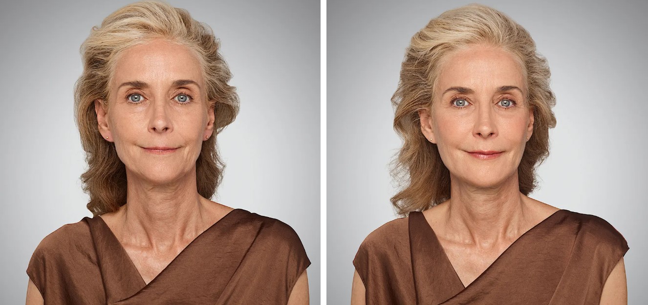 stock-photo-from-discover.juvederm.com.jpg stock-photo-from-discover.juvederm.com.jpg