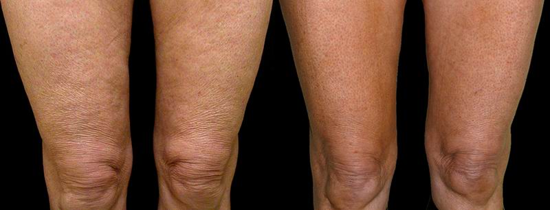 thermage_body_seattle09.jpg
