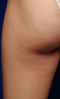 After Thermage treatment for cellulite