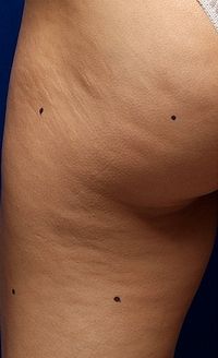 Before Thermage treatment for cellulite